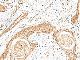 Immunohistochemistry of paraffin-embedded Human esophagus cancer tissue using ELF3 Polyclonal Antibody at dilution of 1:60(×200)