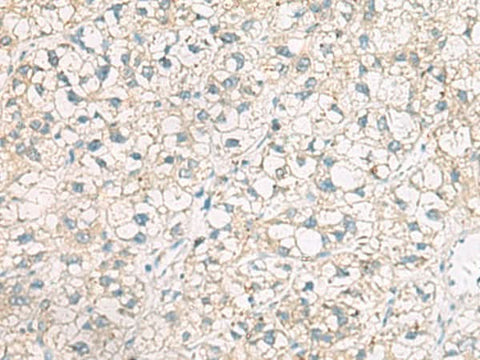 Immunohistochemistry of paraffin-embedded Human liver cancer tissue using POFUT1 Polyclonal Antibody at dilution of 1:50(×200)