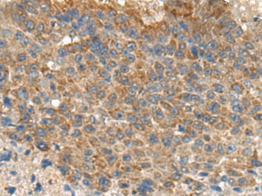 Immunohistochemistry of paraffin-embedded Human liver cancer tissue using MIA Polyclonal Antibody at dilution of 1:180(×200)