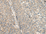 Immunohistochemistry of paraffin-embedded Human liver cancer tissue using CC2D1A Polyclonal Antibody at dilution of 1:35(×200)