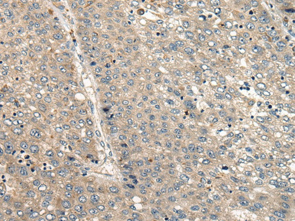 Immunohistochemistry of paraffin-embedded Human liver cancer tissue using CC2D1A Polyclonal Antibody at dilution of 1:35(×200)