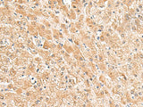 Immunohistochemistry of paraffin-embedded Human liver cancer tissue using TRUB1 Polyclonal Antibody at dilution of 1:85(×200)