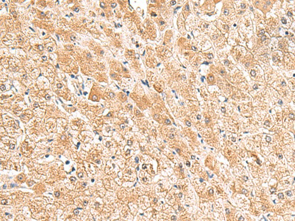 Immunohistochemistry of paraffin-embedded Human liver cancer tissue using TRUB1 Polyclonal Antibody at dilution of 1:85(×200)