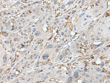 Immunohistochemistry of paraffin-embedded Human esophagus cancer tissue using CD14 Polyclonal Antibody at dilution of 1:40(×200)