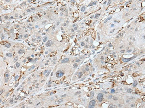 Immunohistochemistry of paraffin-embedded Human esophagus cancer tissue using CD14 Polyclonal Antibody at dilution of 1:40(×200)