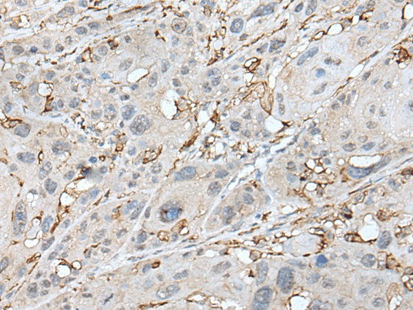 Immunohistochemistry of paraffin-embedded Human esophagus cancer tissue using CD14 Polyclonal Antibody at dilution of 1:40(×200)