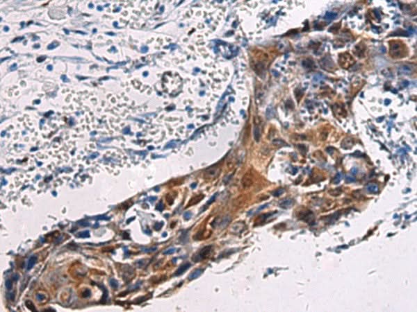 Immunohistochemistry of paraffin-embedded Human esophagus cancer tissue using SORD Polyclonal Antibody at dilution of 1:45(×200)