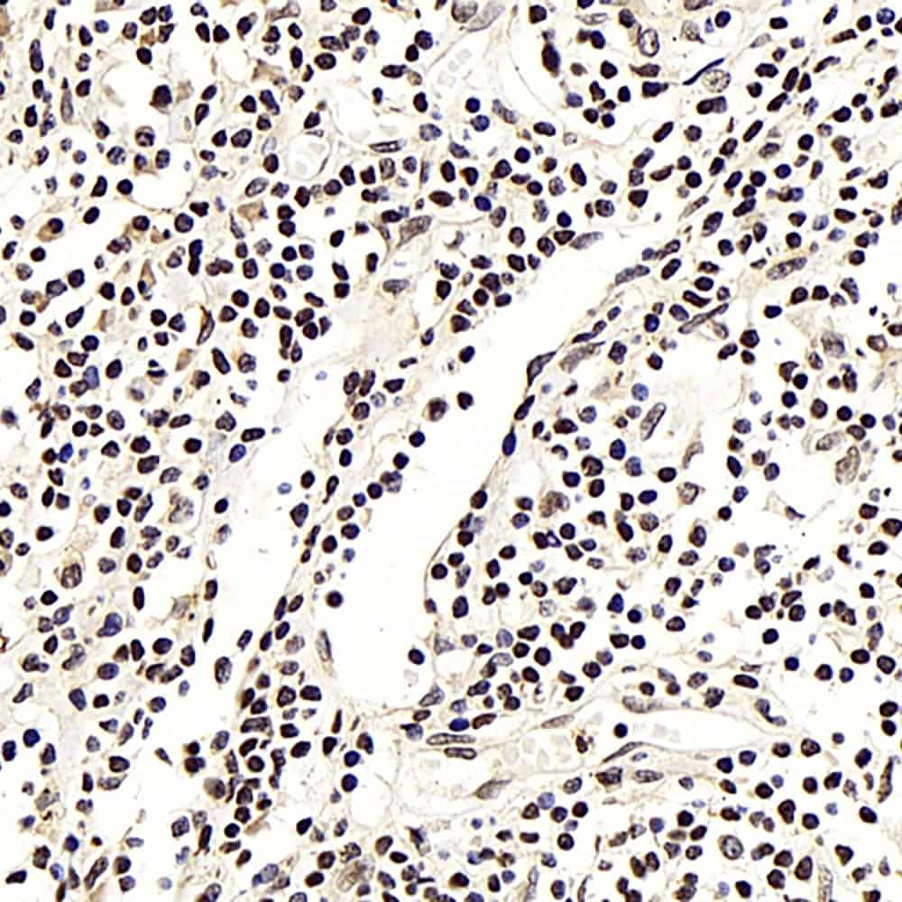 Immunohistochemistry analysis of paraffin-embedded human lung cancer using NFKBIB Polyclonal Antibody at dilution of 1:300.