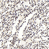 Immunohistochemistry analysis of paraffin-embedded human lung cancer using NFKBIB Polyclonal Antibody at dilution of 1:300.