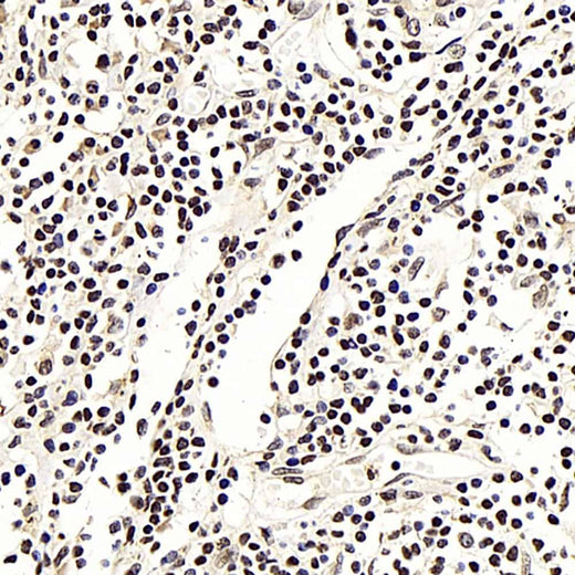 Immunohistochemistry analysis of paraffin-embedded human lung cancer using NFKBIB Polyclonal Antibody at dilution of 1:300.