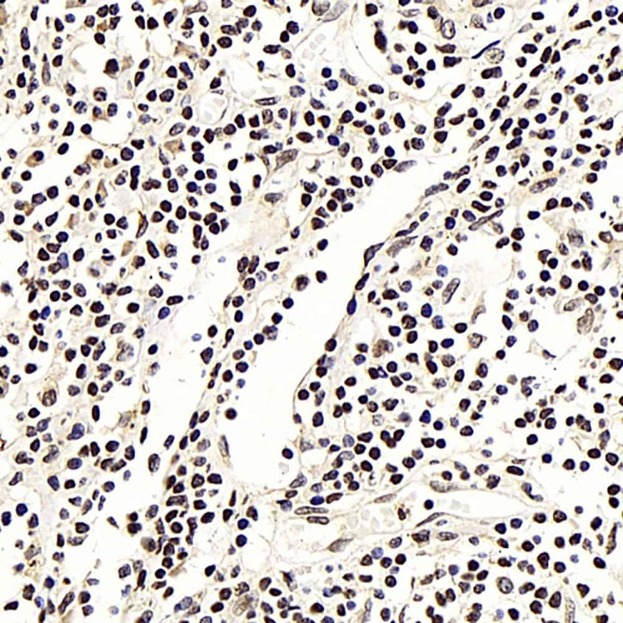 Immunohistochemistry analysis of paraffin-embedded human lung cancer using NFKBIB Polyclonal Antibody at dilution of 1:300.