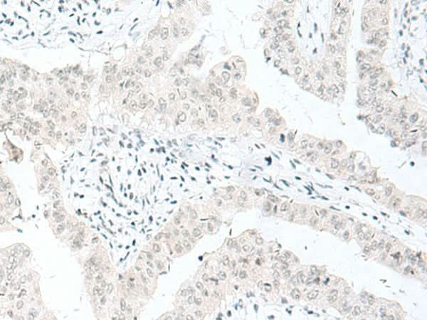 Immunohistochemistry of paraffin-embedded Human liver cancer tissue using ENSA Polyclonal Antibody at dilution of 1:70(×200)