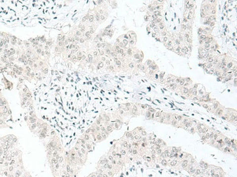 Immunohistochemistry of paraffin-embedded Human liver cancer tissue using ENSA Polyclonal Antibody at dilution of 1:70(×200)