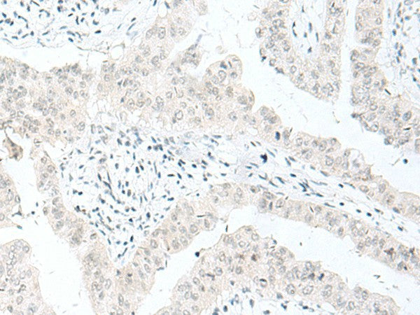 Immunohistochemistry of paraffin-embedded Human liver cancer tissue using ENSA Polyclonal Antibody at dilution of 1:70(×200)
