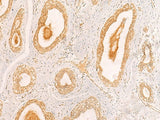 Immunohistochemistry of paraffin-embedded Human breast cancer tissue using ZNF580 Polyclonal Antibody at dilution of 1:40(×200)