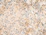 Immunohistochemistry of paraffin-embedded Human cervical cancer tissue using GSKIP Polyclonal Antibody at dilution of 1:45(×200)