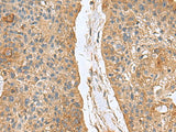 Immunohistochemistry of paraffin-embedded Human esophagus cancer tissue using MARCKSL1 Polyclonal Antibody at dilution of 1:70(×200)