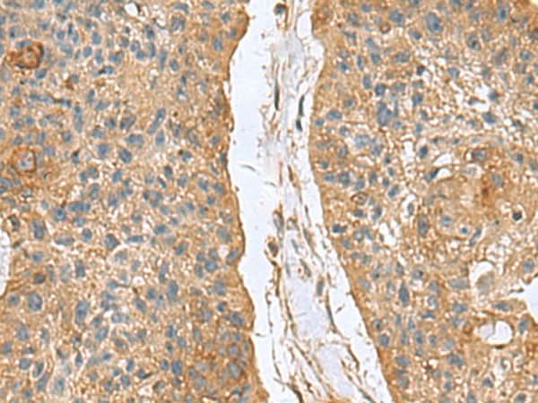 Immunohistochemistry of paraffin-embedded Human esophagus cancer tissue using MARCKSL1 Polyclonal Antibody at dilution of 1:70(×200)