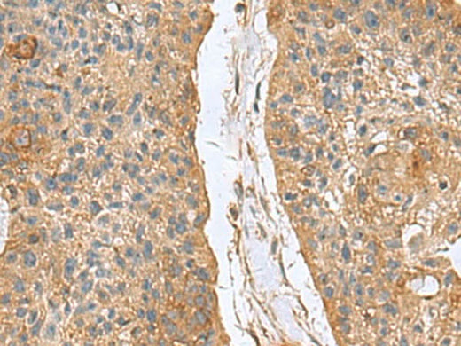 Immunohistochemistry of paraffin-embedded Human esophagus cancer tissue using MARCKSL1 Polyclonal Antibody at dilution of 1:70(×200)