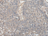 Immunohistochemistry of paraffin-embedded Human liver cancer tissue using GCNT2 Polyclonal Antibody at dilution of 1:55(×200)