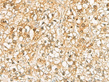 Immunohistochemistry of paraffin-embedded Human liver cancer tissue using C11orf54 Polyclonal Antibody at dilution of 1:70(×200)