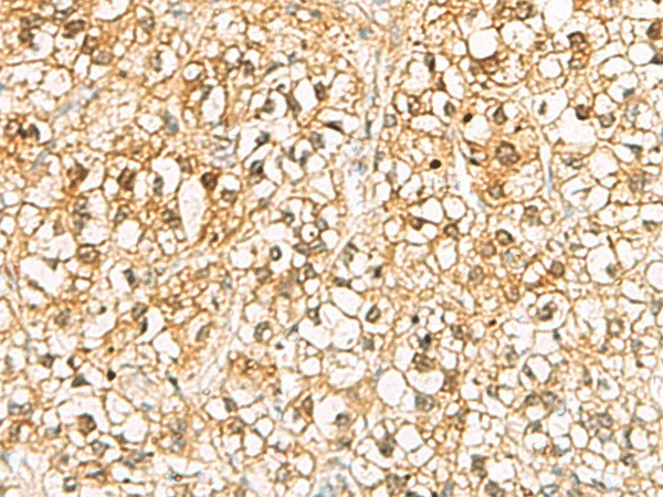 Immunohistochemistry of paraffin-embedded Human liver cancer tissue using C11orf54 Polyclonal Antibody at dilution of 1:70(×200)
