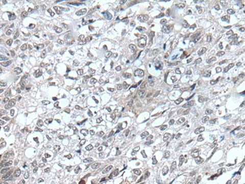 Immunohistochemistry of paraffin-embedded Human lung cancer tissue using FLT4 Polyclonal Antibody at dilution of 1:40(×200)