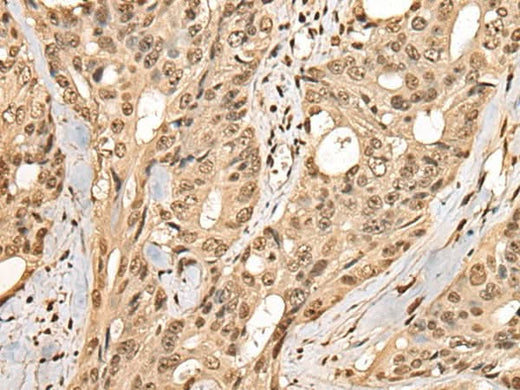 Immunohistochemistry of paraffin-embedded Human colorectal cancer tissue using PHF21A Polyclonal Antibody at dilution of 1:50(×200)