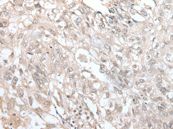 Immunohistochemistry of paraffin-embedded Human lung cancer tissue using VRK3 Polyclonal Antibody at dilution of 1:45(×200)