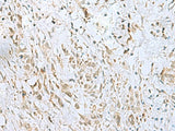 Immunohistochemistry of paraffin-embedded Human gastric cancer tissue using ECT2 Polyclonal Antibody at dilution of 1:35(×200)