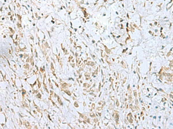 Immunohistochemistry of paraffin-embedded Human gastric cancer tissue using ECT2 Polyclonal Antibody at dilution of 1:35(×200)