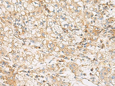 Immunohistochemistry of paraffin-embedded Human liver cancer tissue using FYCO1 Polyclonal Antibody at dilution of 1:60(×200)
