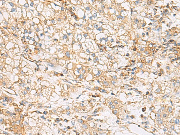 Immunohistochemistry of paraffin-embedded Human liver cancer tissue using FYCO1 Polyclonal Antibody at dilution of 1:60(×200)