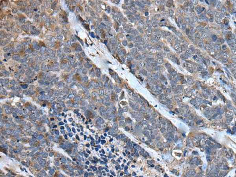 Immunohistochemistry of paraffin-embedded Human thyroid cancer tissue using MCM10 Polyclonal Antibody at dilution of 1:50(×200)
