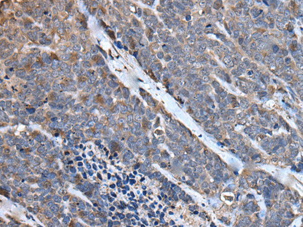 Immunohistochemistry of paraffin-embedded Human thyroid cancer tissue using MCM10 Polyclonal Antibody at dilution of 1:50(×200)