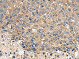 Immunohistochemistry of paraffin-embedded Human liver cancer tissue using CD59 Polyclonal Antibody at dilution of 1:120(×200)