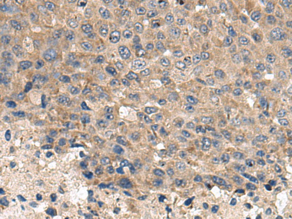 Immunohistochemistry of paraffin-embedded Human liver cancer tissue using CD59 Polyclonal Antibody at dilution of 1:120(×200)