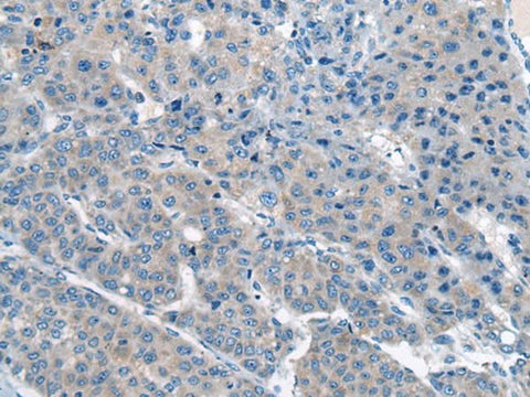Immunohistochemistry of paraffin-embedded Human liver cancer tissue using CITED4 Polyclonal Antibody at dilution of 1:65(×200)