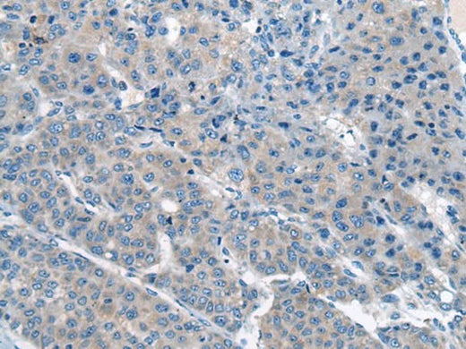 Immunohistochemistry of paraffin-embedded Human liver cancer tissue using CITED4 Polyclonal Antibody at dilution of 1:65(×200)