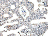 Immunohistochemistry of paraffin-embedded Human colorectal cancer tissue using TCEB2 Polyclonal Antibody at dilution of 1:40(×200)