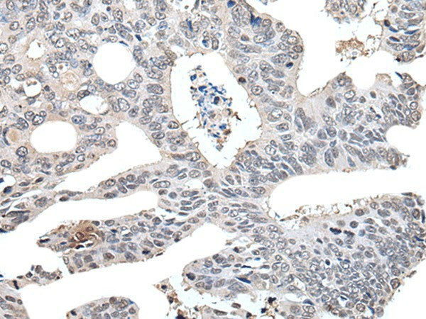 Immunohistochemistry of paraffin-embedded Human colorectal cancer tissue using TCEB2 Polyclonal Antibody at dilution of 1:40(×200)