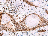 Immunohistochemistry of paraffin-embedded Human esophagus cancer tissue using SF3B3 Polyclonal Antibody at dilution of 1:50(×200)