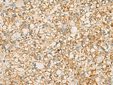 Immunohistochemistry of paraffin-embedded Human liver cancer tissue using PDCL Polyclonal Antibody at dilution of 1:40(×200)