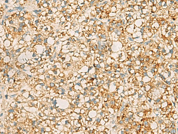 Immunohistochemistry of paraffin-embedded Human liver cancer tissue using PDCL Polyclonal Antibody at dilution of 1:40(×200)