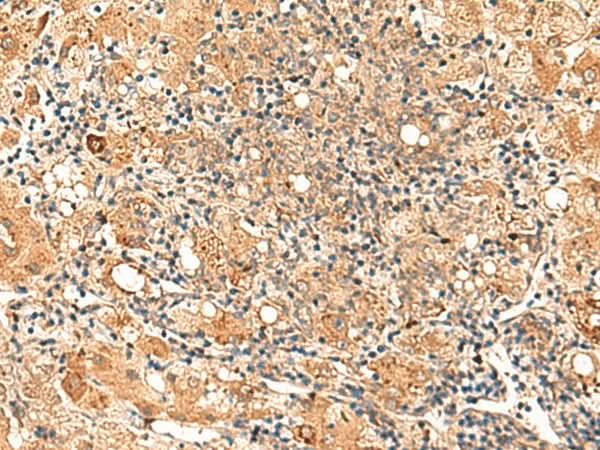 Immunohistochemistry of paraffin-embedded Human liver cancer tissue using GALNT12 Polyclonal Antibody at dilution of 1:70(×200)
