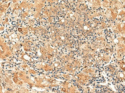 Immunohistochemistry of paraffin-embedded Human liver cancer tissue using GALNT12 Polyclonal Antibody at dilution of 1:70(×200)