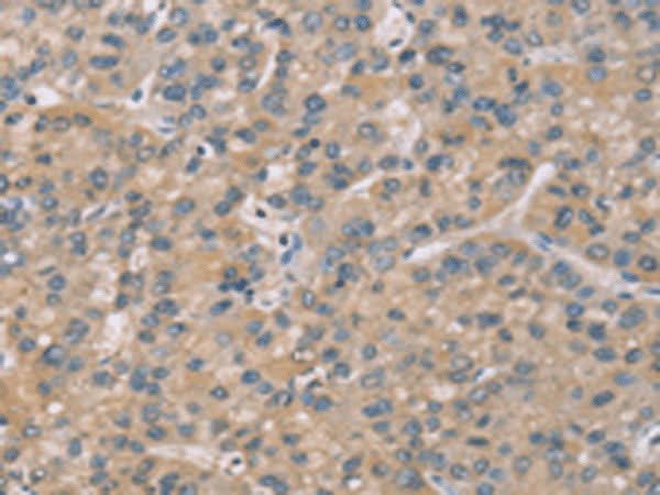 Immunohistochemistry of paraffin-embedded Human liver cancer tissue using ZBTB3 Polyclonal Antibody at dilution of 1:50(×200)
