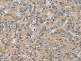 Immunohistochemistry of paraffin-embedded Human liver cancer tissue using ZBTB3 Polyclonal Antibody at dilution of 1:50(×200)