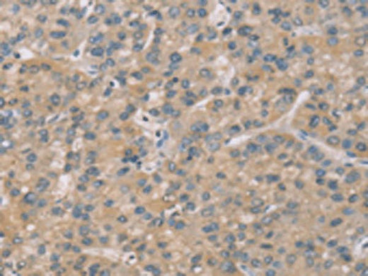 Immunohistochemistry of paraffin-embedded Human liver cancer tissue using ZBTB3 Polyclonal Antibody at dilution of 1:50(×200)
