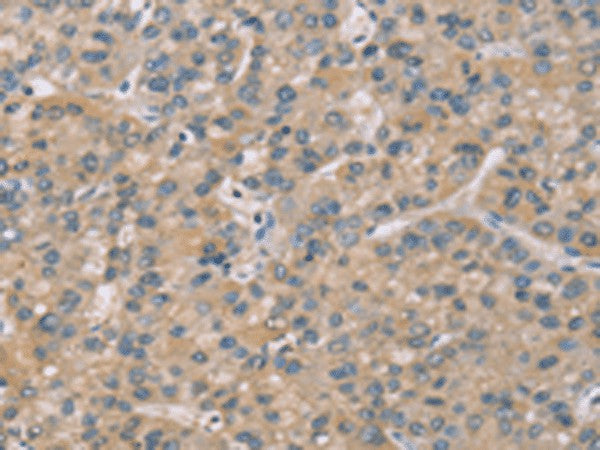 Immunohistochemistry of paraffin-embedded Human liver cancer tissue using ZBTB3 Polyclonal Antibody at dilution of 1:50(×200)